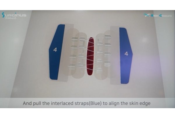 [KIMES 2021] Surginus introduces foldable skin closure that requires no ...